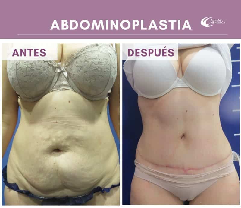 Abdominoplastia. Reducción de abdomen