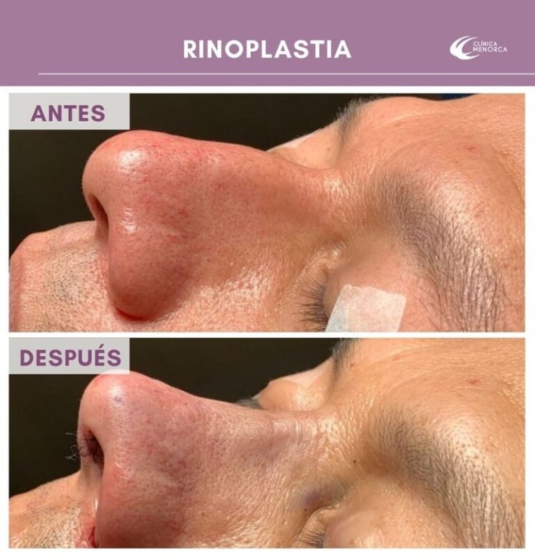 cm-rinoplastia-antesydespues-05