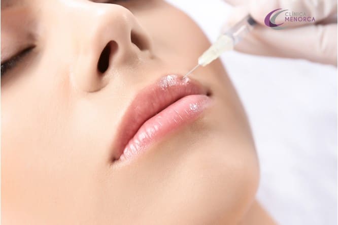 lip lift tendencia famosas